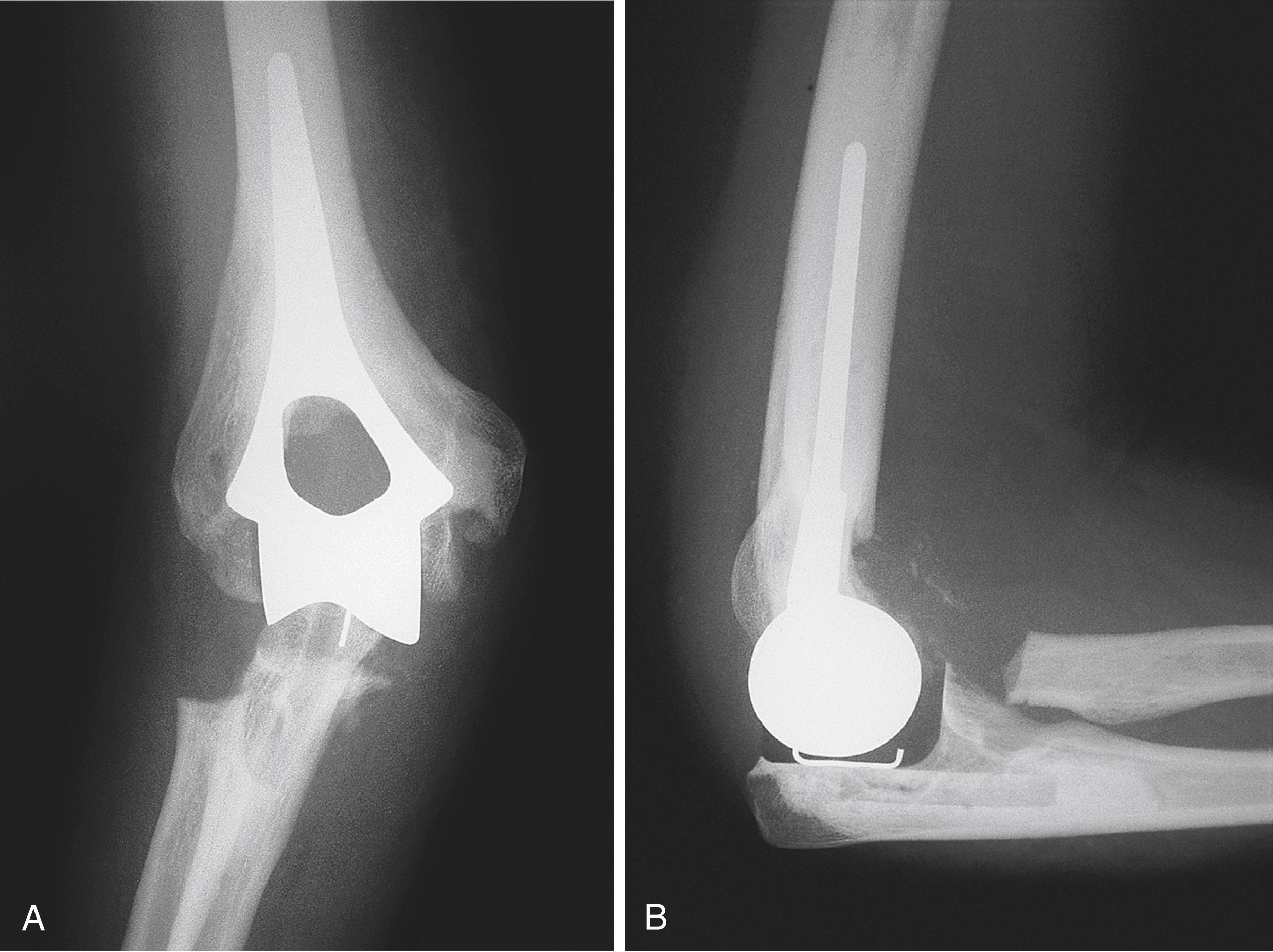 Fig. 27.1, Anteroposterior (A) and lateral (B) radiographs of a Souter-Strathclyde unlinked implant. The ulnar component consists of polyethylene, which is radiolucent.