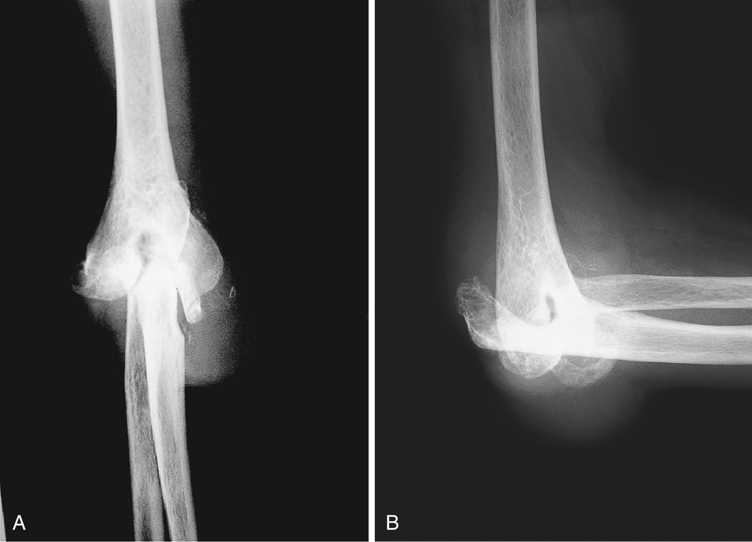 Fig. 27.2, Anteroposterior (A) and lateral (B) radiographs of a severe stage IV rheumatoid elbow. The loss of bone support and ligamentous integrity leads to gross joint instability.