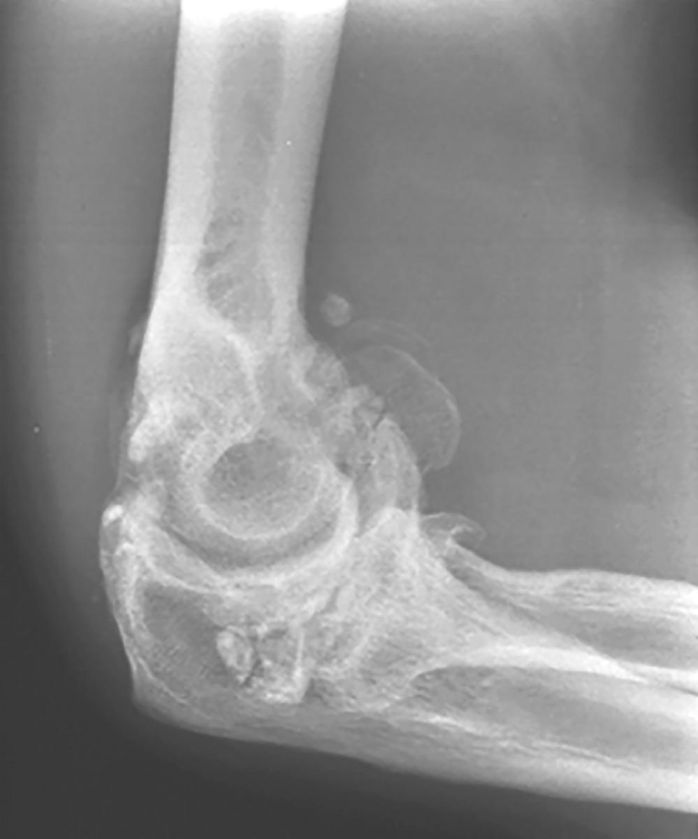 FIG 95.1, An extreme form of hypertrophic reaction is an indication for replacement but is associated with postoperative stiffness in many instances.