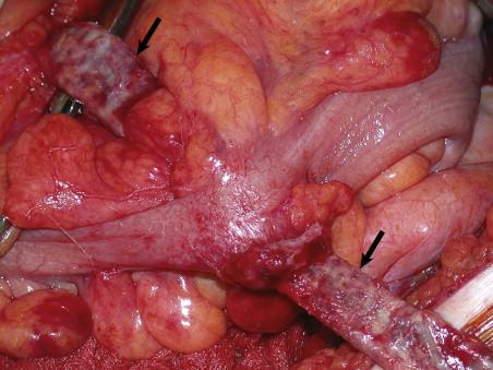 Figure 33-1, Intraoperative photograph of the left limb of an infected aortofemoral graft (arrows) tunneled through the sigmoid colon.