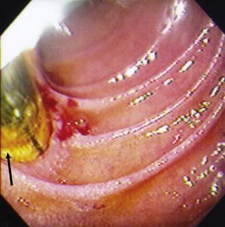 Figure 33-2, Endoscopic photograph taken during gastroduodenoscopy demonstrating an aortoenteric fistula. Note the black line in the synthetic graft and the bile staining of the graft material (arrow).