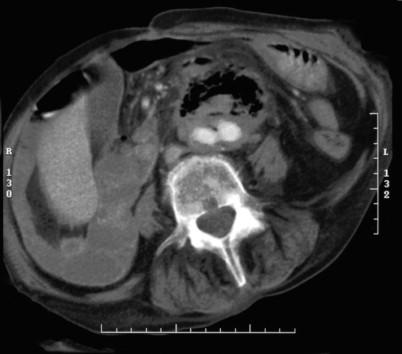 Figure 33-3, CT scan demonstrating gas in an aneurysm sac adjacent to an infected aortobiiliac synthetic graft.