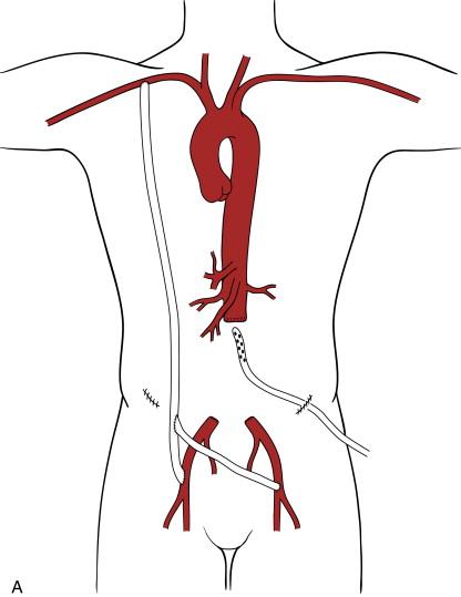 Figure 33-4, A, Right axillobifemoral extraanatomic bypass graft performed to provide lower extremity perfusion after removal of an infected aortobiiliac synthetic graft. Note the large sump drain placed in the aortic bed and brought out through the left flank. B, Bilateral axilloproximal superficial femoral artery extraanatomic bypass grafts performed to provide lower extremity perfusion after removal of an infected aortobifemoral synthetic graft. Note the autogenous patch angioplasties used to maintain femoral perfusion.