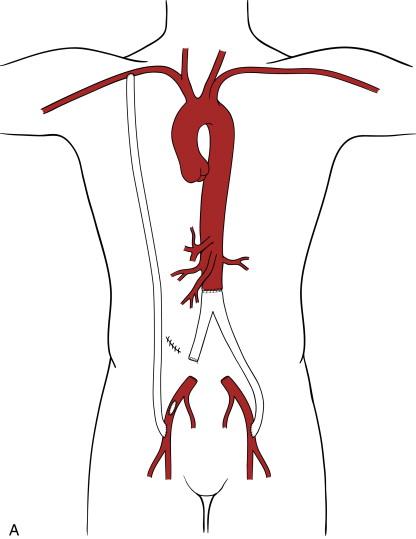 Figure 33-5, A, Right axilloproximal superficial femoral artery extraanatomic bypass graft performed to provide lower extremity perfusion after removal of an infected right distal limb of an aortobifemoral synthetic graft. The limb resection was performed through a clean right retroperitoneal approach. The rest of the original graft was not involved in the right groin infection. B, An obturator bypass graft is performed to provide lower extremity perfusion after removal of an infected right distal limb of an aortobifemoral synthetic graft. The limb resection and distal anastomosis are first performed through clean right retroperitoneal and proximal thigh incisions. The rest of the original graft was not involved in the right groin infection.