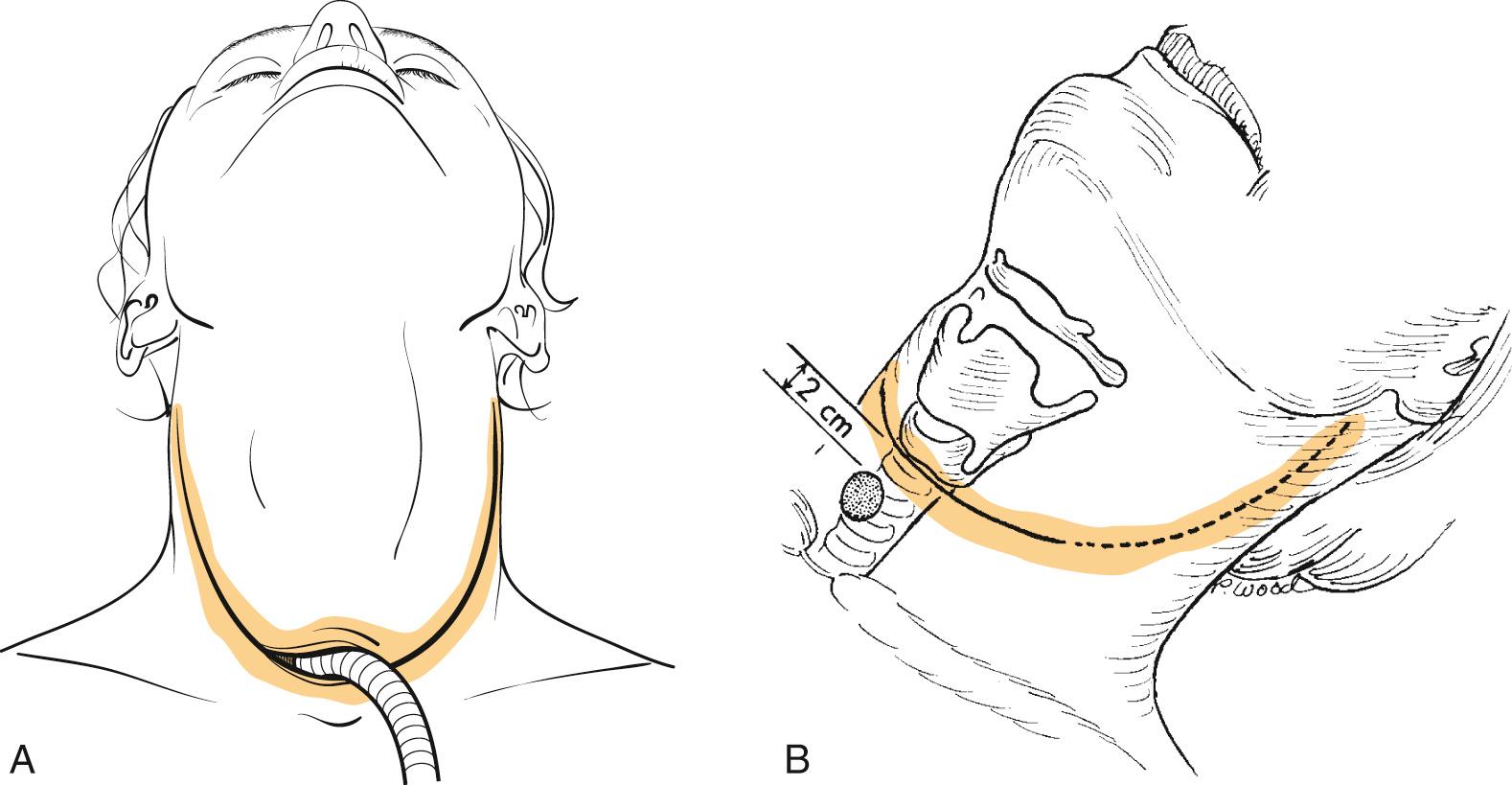 Fig. 109.1, Incision options for total laryngectomy and total laryngopharyngectomy.