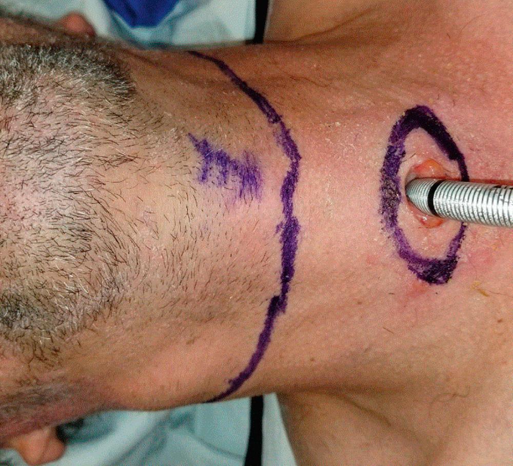 Fig. 109.2, Incision design showing the short flap approach with skin bridge between existing tracheostomy site and the flap. The stoma will be created with ellipse around the tracheostomy site in this approach.