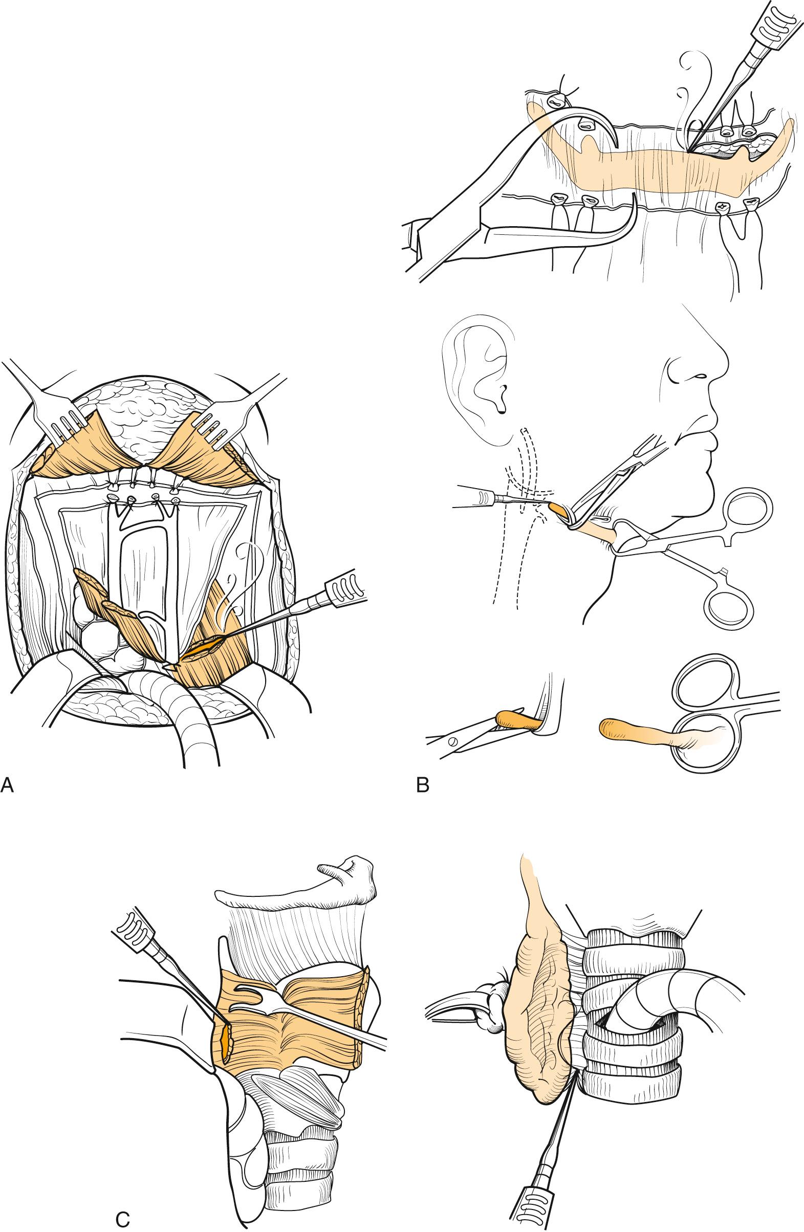 Fig. 109.3, Skeletonization of the larynx.