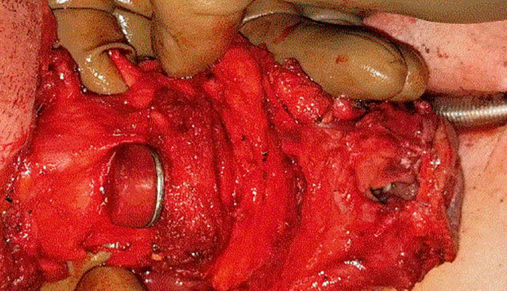 Fig. 109.5, Entry into vallecula is facilitated by placing a Deaver retractor transorally and incision after hyoid is skeletonized. This is the easiest entry point for a tumor that does not involve the vallecula or base of tongue. Note that the hyoid is pulled down from the greater cornua and has been skeletonized, and the hypoglossal nerves have been protected during both skeletonization and entry.