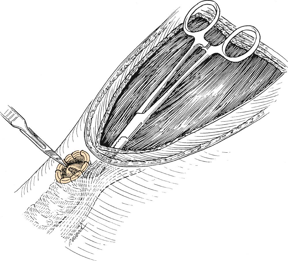 Fig. 109.6, Technique of tracheoesophageal puncture.