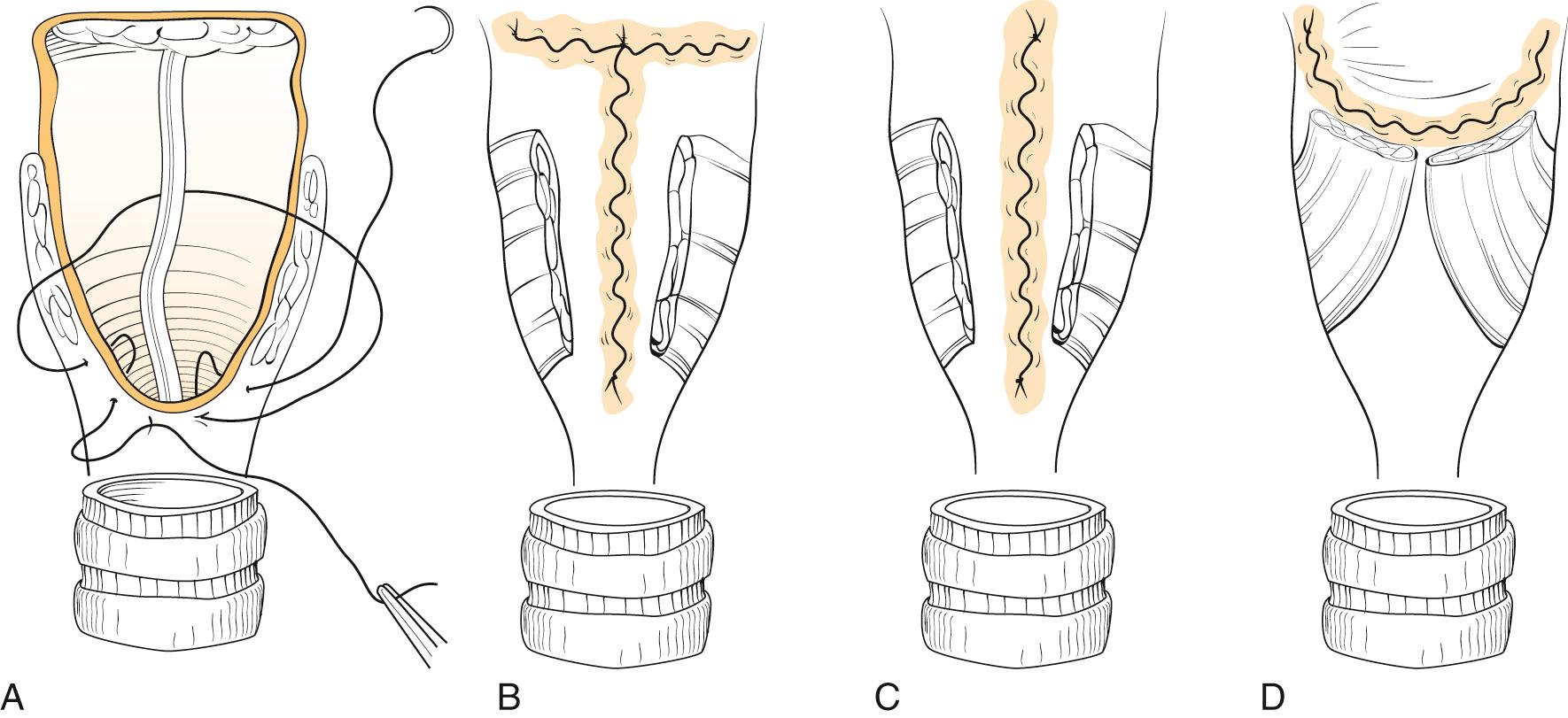 Fig. 109.7, (A) Closure of pharynx with detail of suturing technique. (B) T-closure. (C) Vertical closure. (D) Horizontal closure.