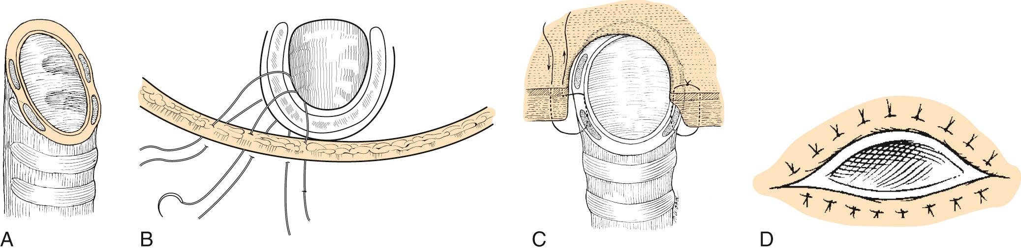 Fig. 109.8, Steps to avoid stenosis in creation of tracheostoma (long-flap incision).