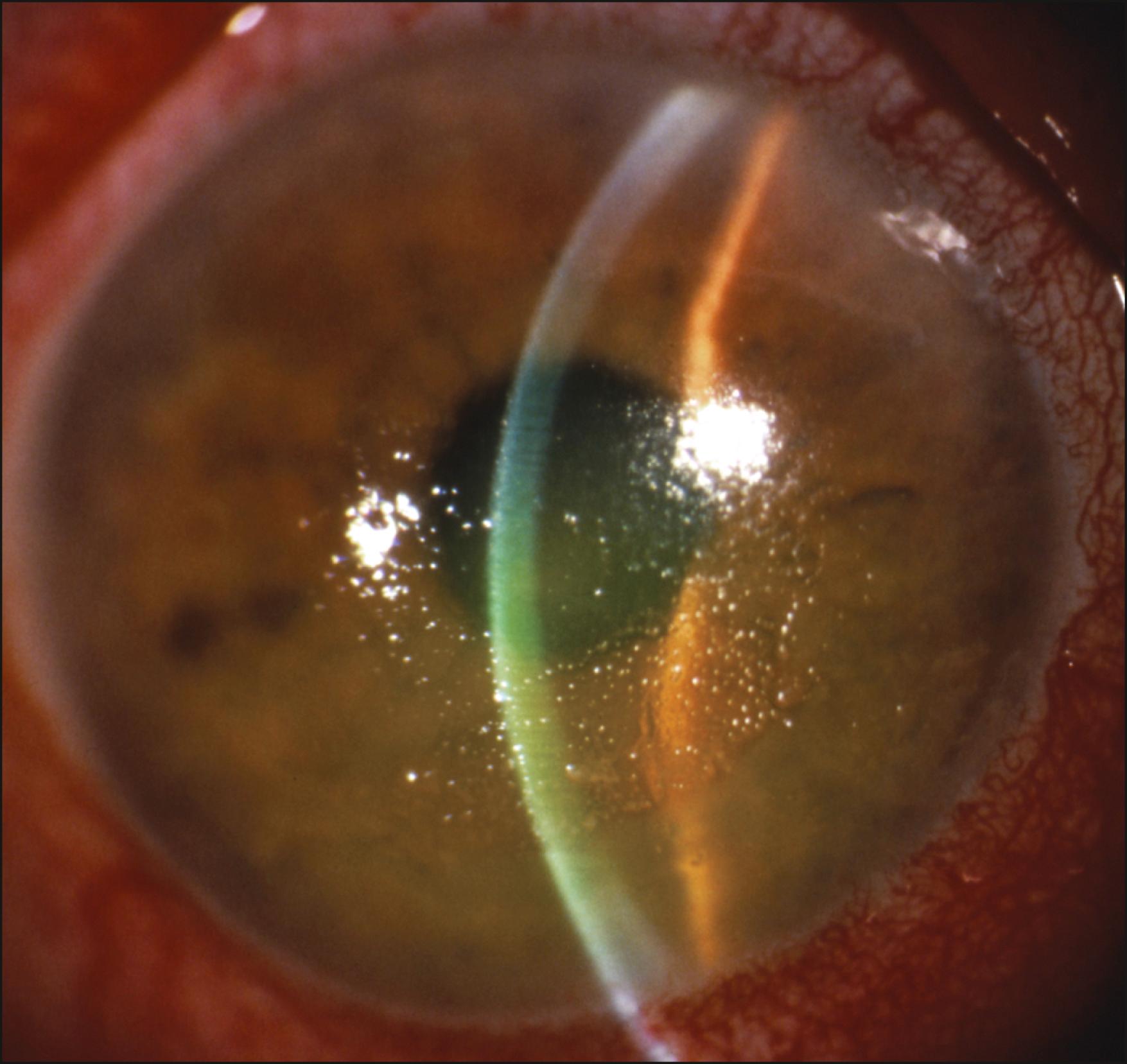 Fig. 47.1, Toxic ulcerative keratopathy secondary to preservatives in artificial tear solutions. Note the oval epithelial defect with coarse surrounding keratitis, resembling a “comet’s impact” crater. The epithelial defect has a well-defined, rolled margin. Marked inferior and inferonasal conjunctival injection is present, as well as intense ciliary flush.