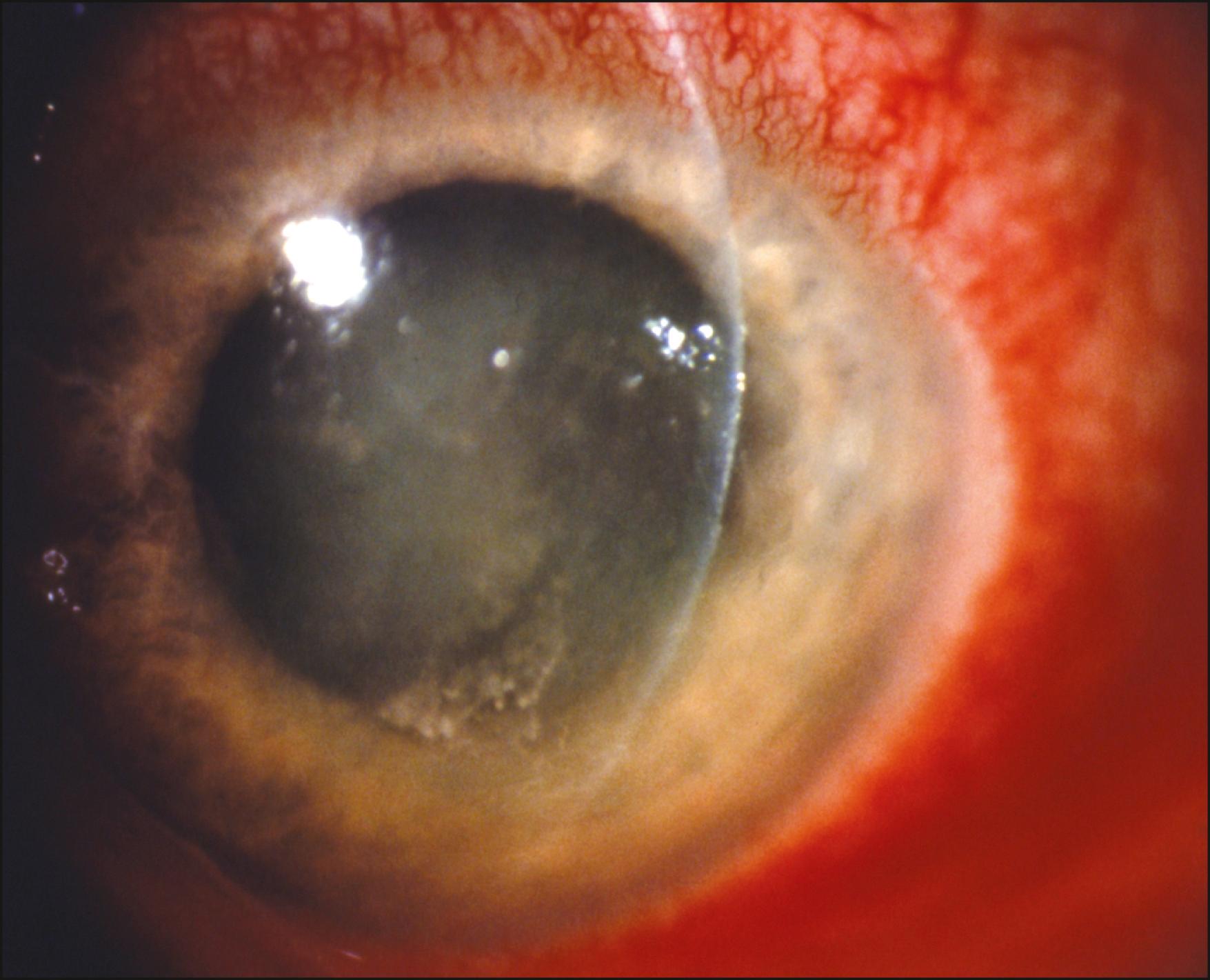 Fig. 47.2, Toxic keratoconjunctivitis secondary to topical gentamicin. The epithelium is diffusely irregular, but more so inferiorly. The increased conjunctival injection inferiorly and inferonasally is characteristic.