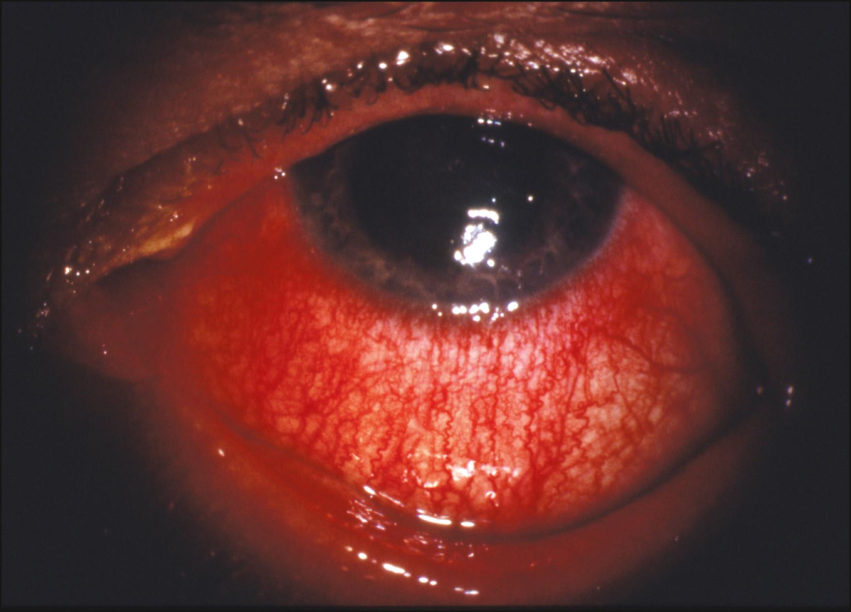 Fig. 47.3, Toxic keratoconjunctivitis secondary to topical trifluorothymidine (Viroptic). Once again, seen here is the characteristic corneal epithelial irregularity and conjunctival injection more prominent in the inferior aspect of the eye.