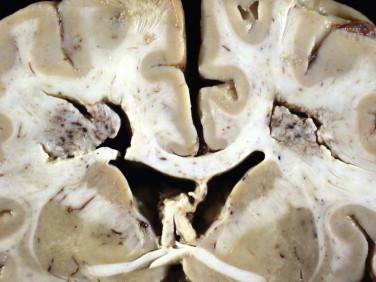 Fig 1, Toxic leukoencephalopathy. There is bilateral necrosis and discoloration of the deep white matter in this patient who died after a substance abuse “binge.”