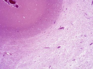 Fig 2, Toxic leukoencephalopathy. At low magnification there is extensive white matter pallor due to widespread necrosis. Note that a band of subcortical white matter (“U-fibers”) ( upper center and left ) is relatively spared. (The cerebral cortex is at the upper left of this image. )