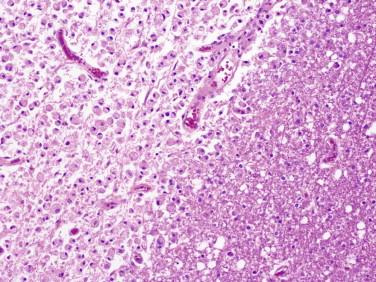 Fig 3, Toxic leukoencephalopathy. Higher magnification shows a sharply demarcated area of white matter necrosis with abundant macrophages ( left side of image ).