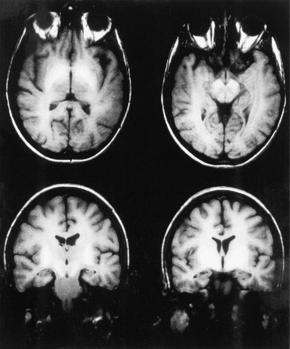 Fig. 84.1, T1-weighted magnetic resonance images from a patient with cirrhosis of the liver. Note high signal in basal ganglia, cerebral peduncles, and substantia nigra.