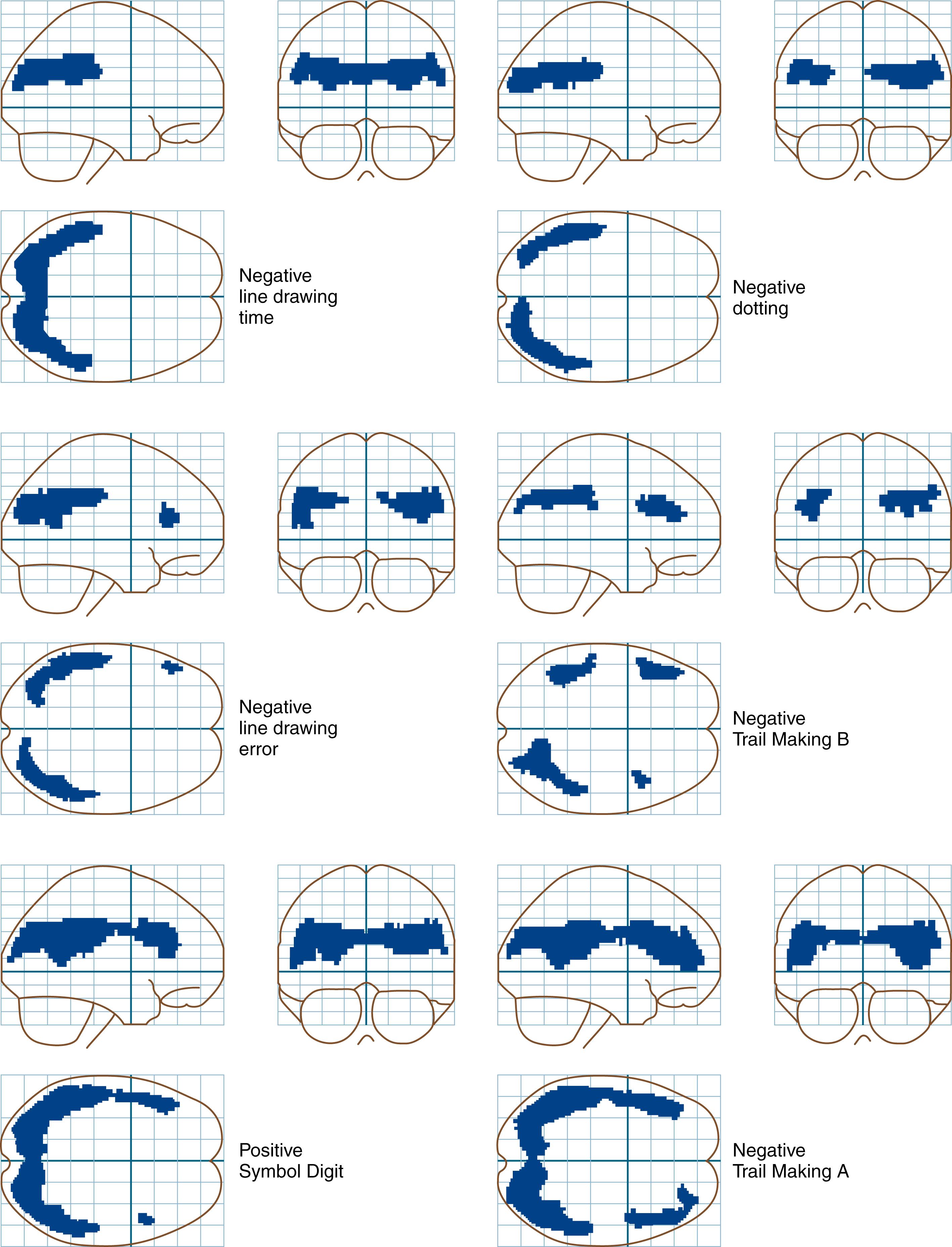 Fig. 84.2, Correlations between performance in the various subtests of the PSE Syndrome Test, as measured by age-corrected z scores, and cerebral glucose metabolism, as measured by fluorodeoxyglucose-positron emission tomography metabolism. Only those subjects able to complete the test are included in the analyses. The statistical parametric mapping Z image projections show significant correlations with bilateral parietal associative cortex, with increasing correlations with frontal regions.