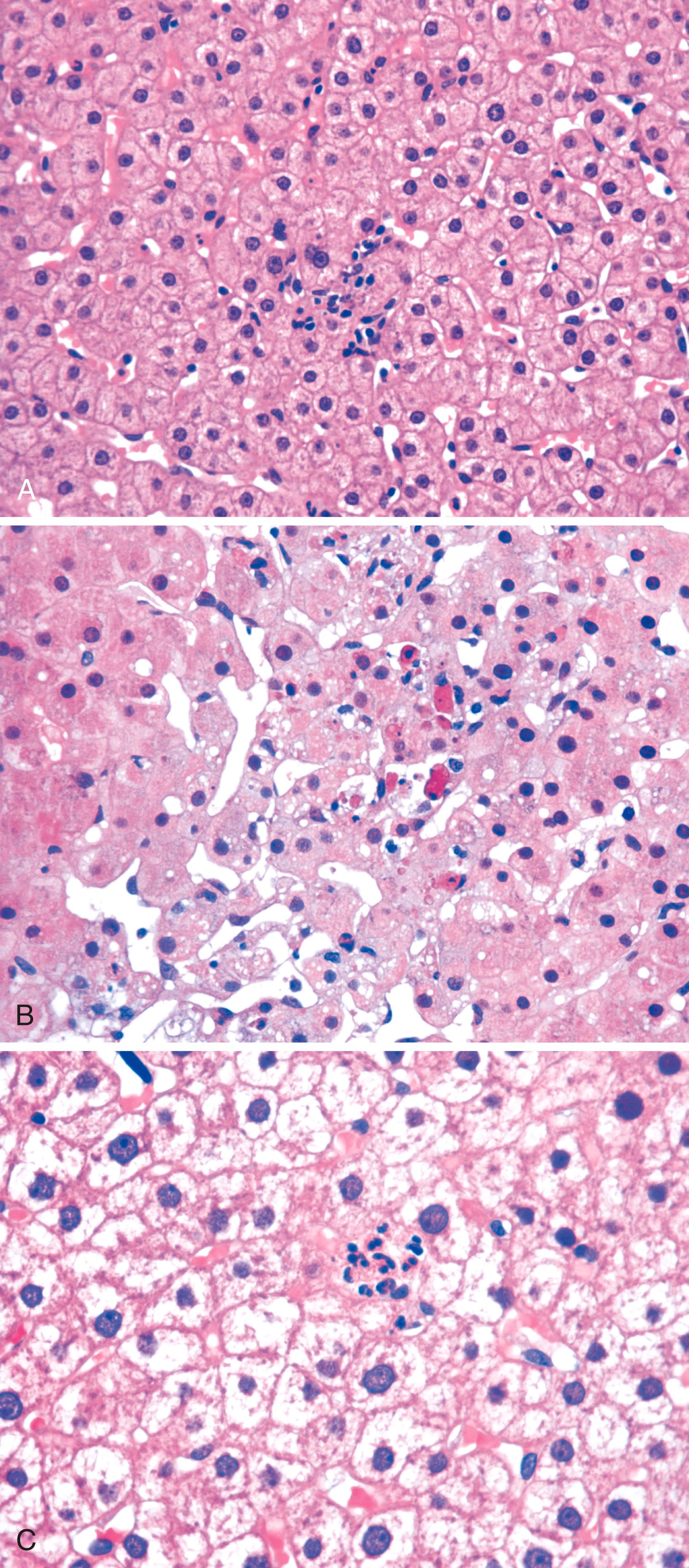 FIGURE 49.2, Hepatitis with spotty necrosis/apoptosis.