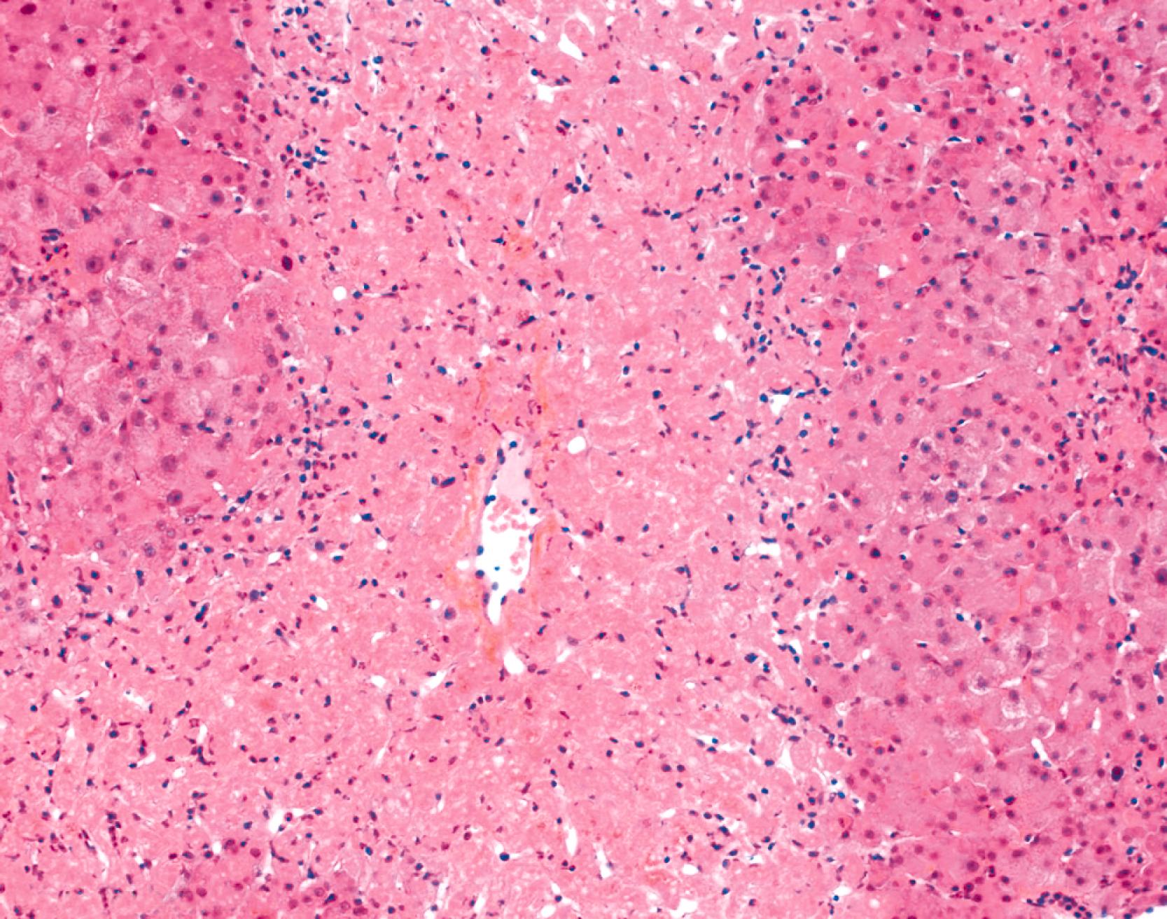 FIGURE 49.3, Acute hepatitis with zonal centrilobular necrosis in acetaminophen-induced subfulminant hepatitis. Coagulation necrosis and hepatocyte dropout are present around centrilobular veins.