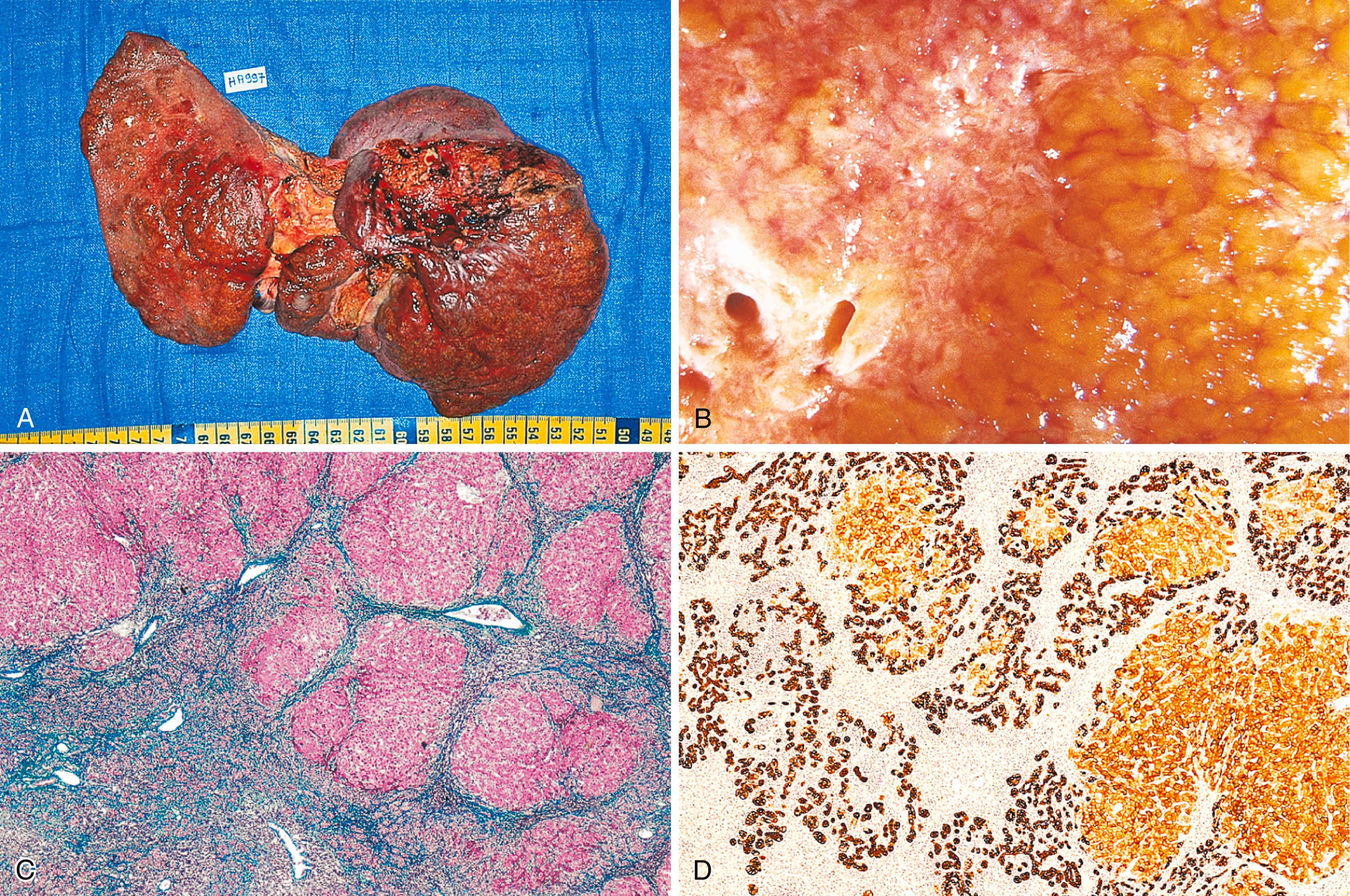 FIGURE 49.4, Subfulminant hepatitis in a 47-year-old woman who took alpidem (Ananxyl) for 6 months (150 mg/day).