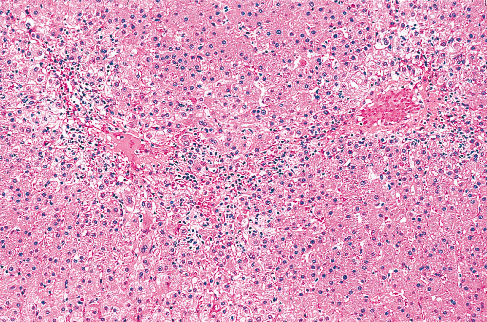 FIGURE 49.5, Submassive acute hepatitis caused by cocaine use in a 20-year-old man showing perivenular and bridging necrosis, mixed with an inflammatory reaction.