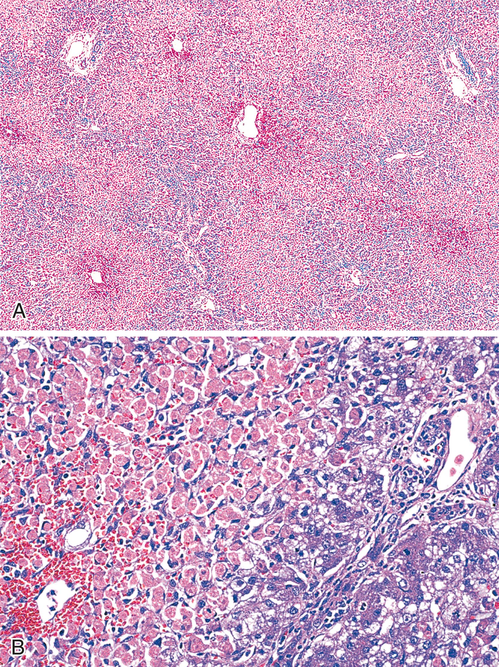 FIGURE 49.6, Fulminant liver failure in a 1-year-old child with a history of acetaminophen overdose (therapeutic misadventure: doses four times the normal daily dose for 4 days); section from liver explant.