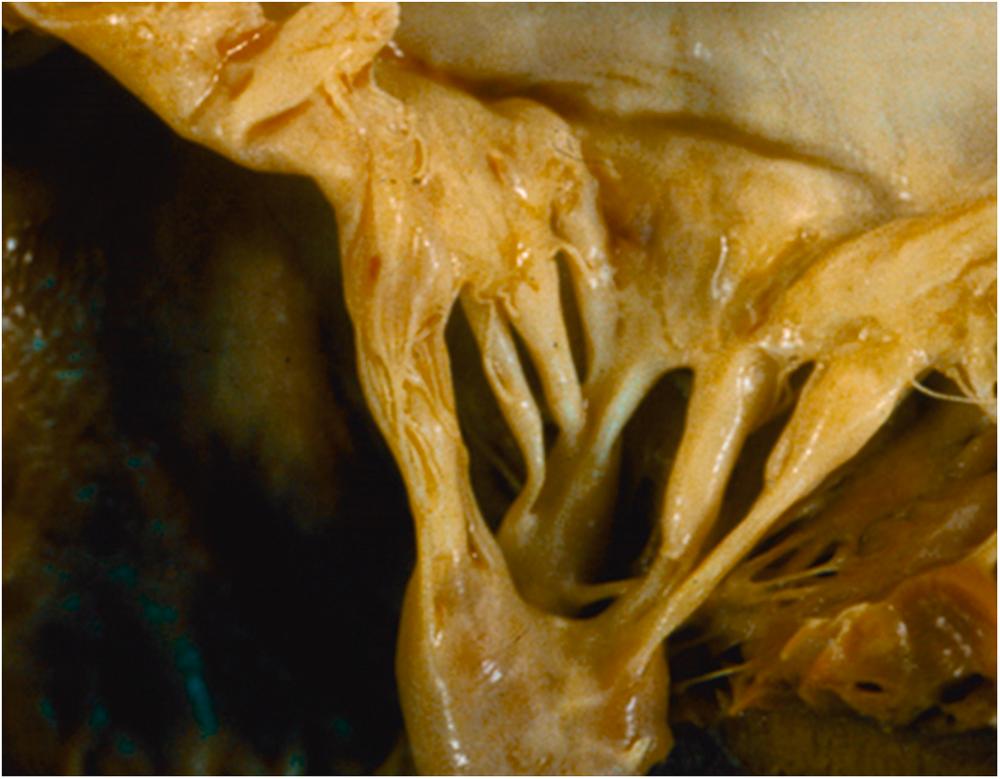 Figure 12.1, Mitral valve from patient who was taking methysergide for migraine headaches. Note thickened chordae and valve leaflet.