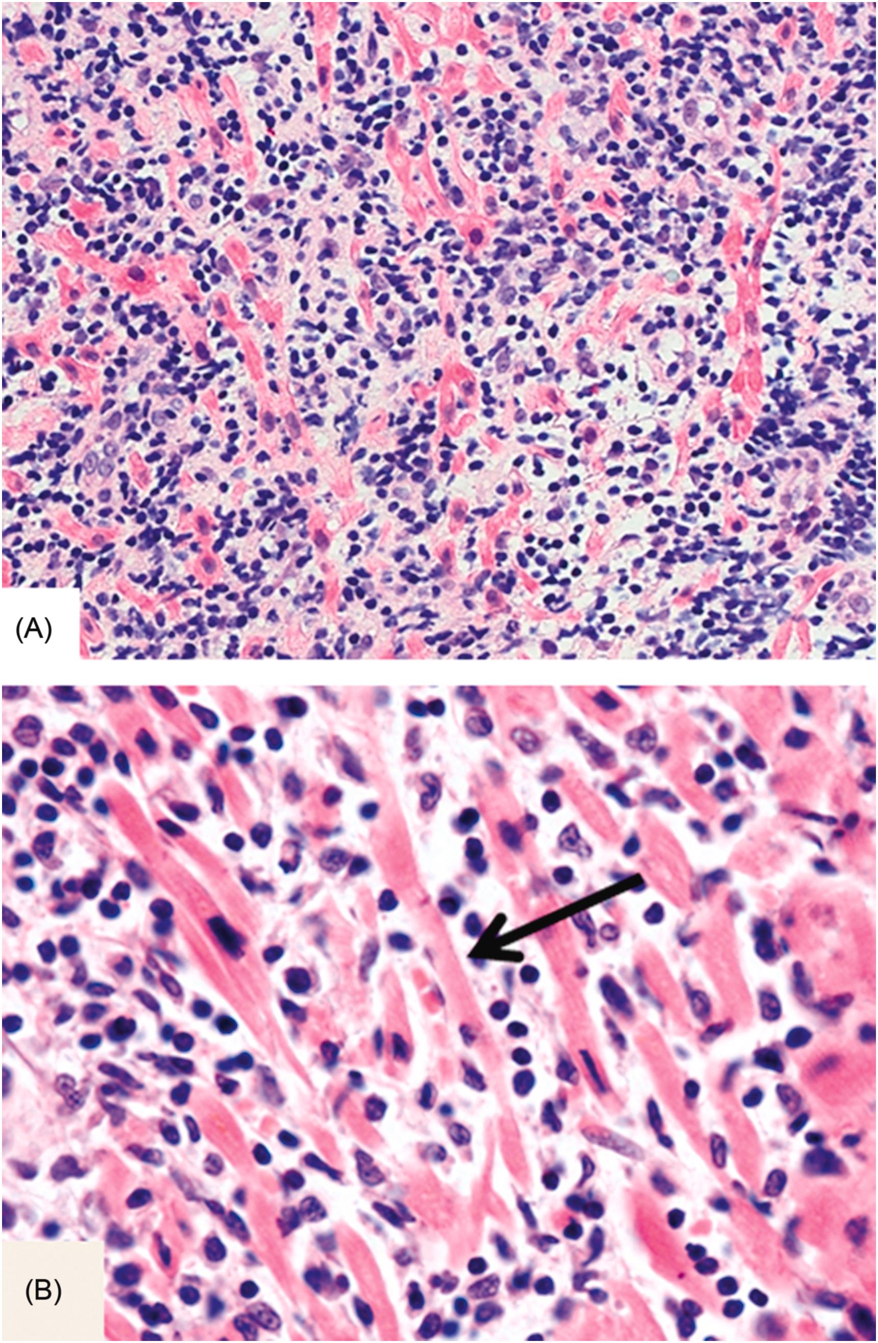 Figure 12.3, Myocarditis in a patient treated with interleukin-2. Note intense inflammation composed of lymphoid cells and macrophages. There is myocyte dropout and injury (arrow) as well [H&E stain: (A) 100×, (B) 400×].