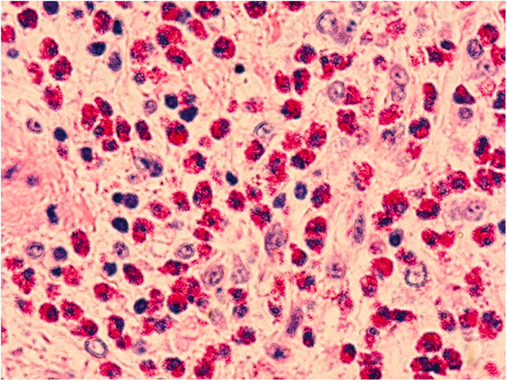 Figure 12.4, Section from explanted heart of patient undergoing transplantation showing severe eosinophilic/hypersensitivity myocarditis. The patient was on 31 medications including antibiotics and inotropic agents (H&E stain 400×).