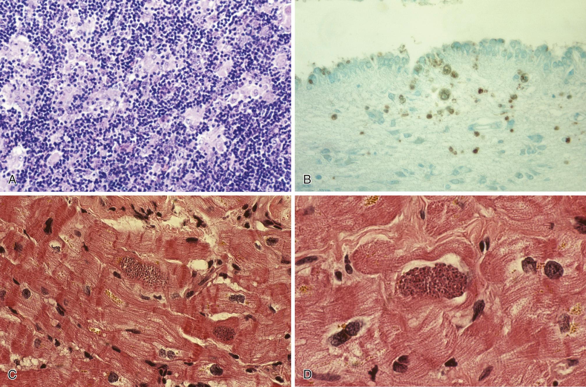 FIG. 278.3, Histologic features of Toxoplasma gondii in humans.