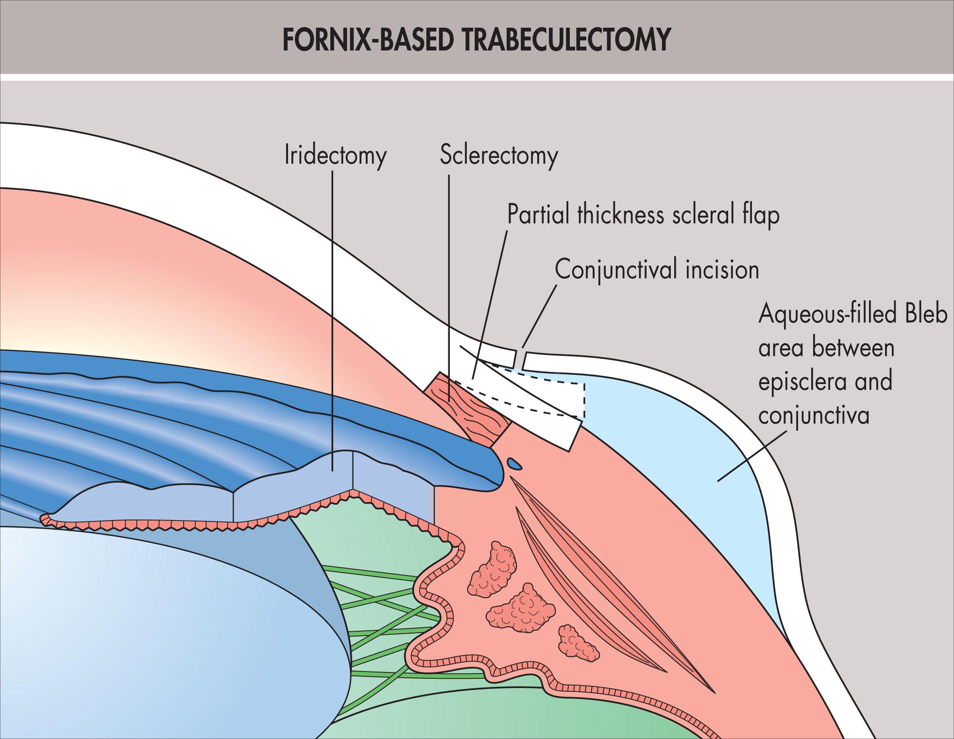 Fig. 10.27.1, Fornix-Based Trabeculectomy.