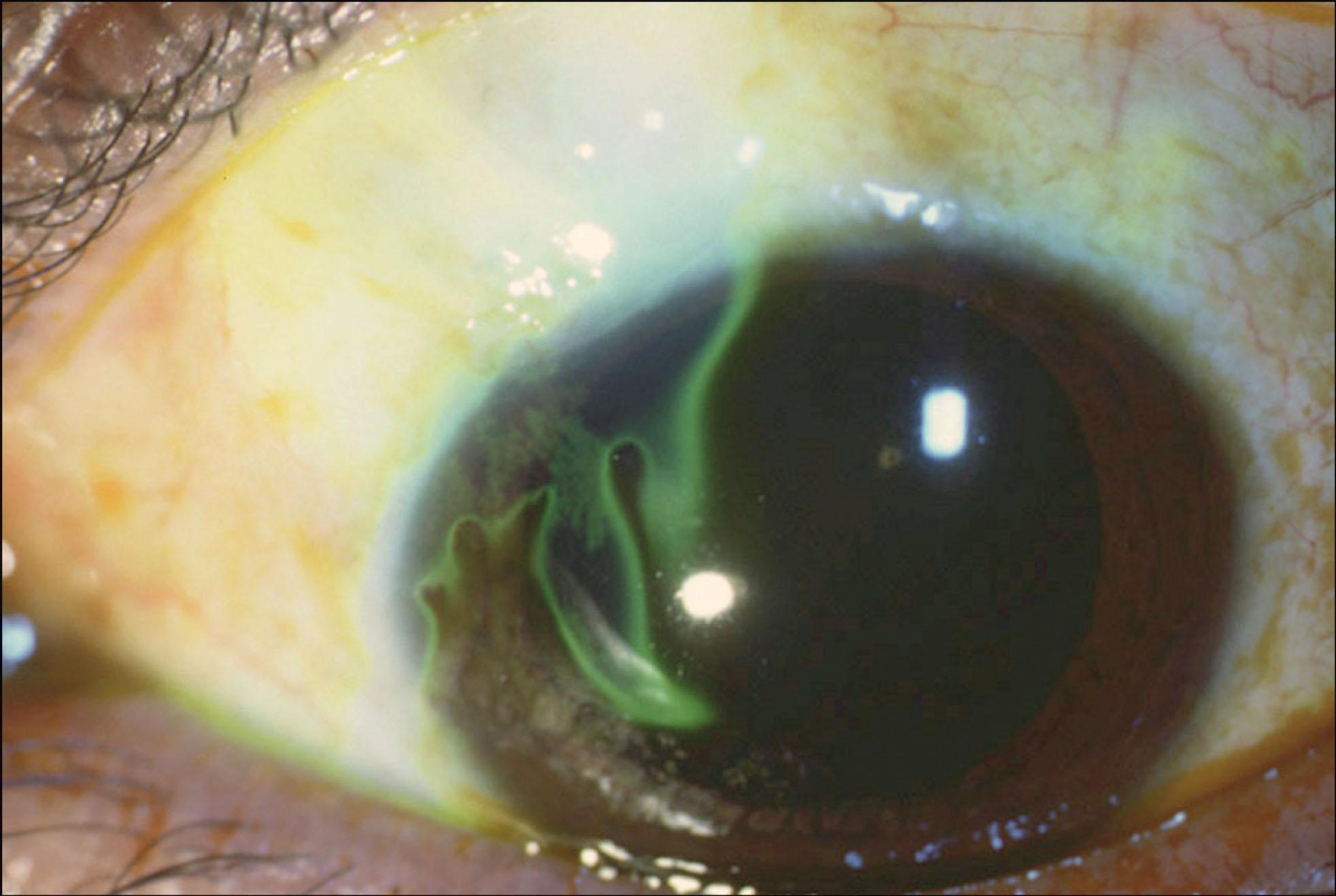 Fig. 10.27.2, Leaking Bleb With Positive Seidel Sign After Fluorescein Dye Is Applied.