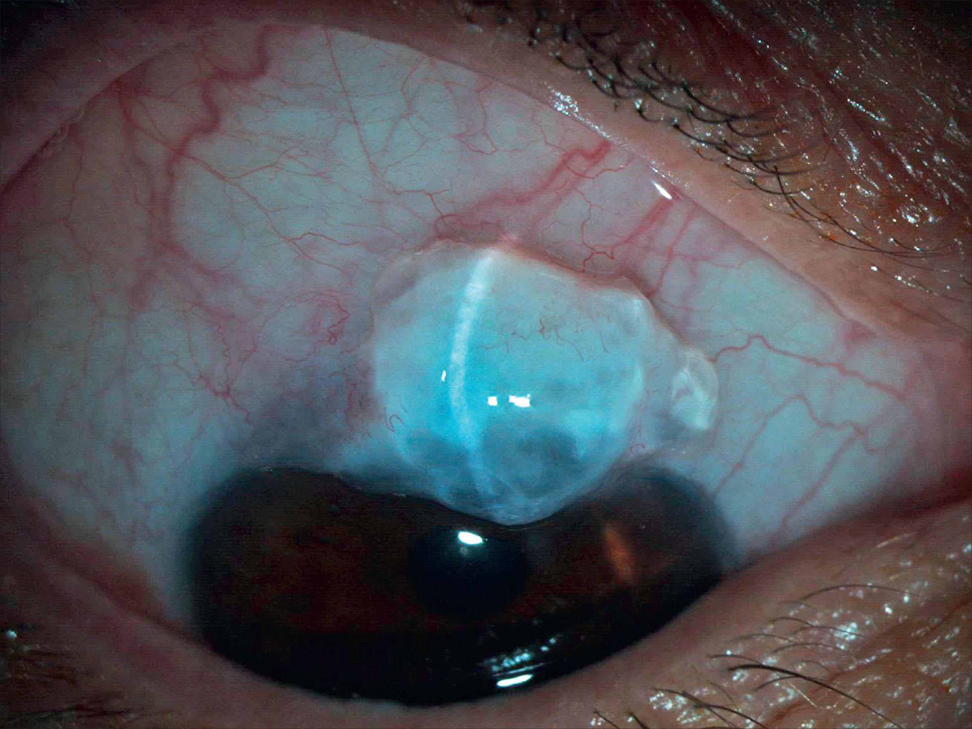 Fig. 10.27.3, Example of Localized, Cystic, Thin-Walled Bleb.