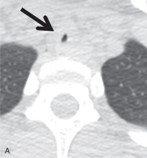 Figure 36.2, A 21-year-old female patient with postintubation stenosis at a typical location in the upper portion of the intrathoracic trachea. Axial CT images in lung (A) and mediastinal (B) window settings show severe circumferential narrowing (arrows) of the trachea with wall thickening. Sagittal minimum intensity projection reformation CT (C), and three-dimensional reconstruction (D) images show typical hourglass-like narrowing (arrows) of the trachea.