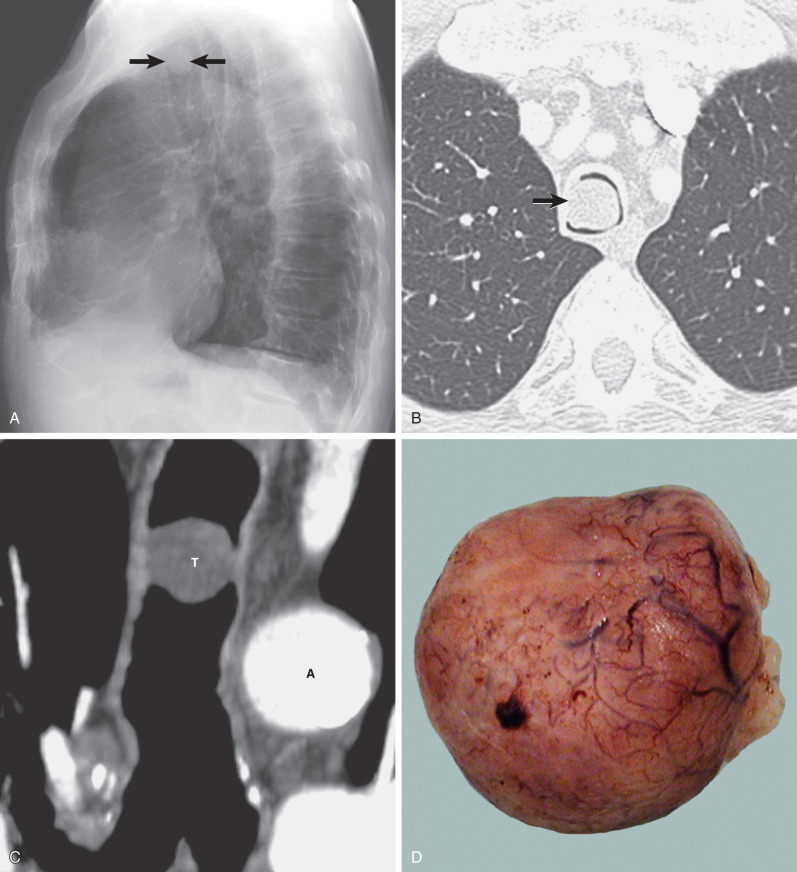 Fig. 56.1, Benign tracheal neoplasm, neurofibroma. (A) Lateral chest radiograph demonstrates a smoothly marginated round mass within the tracheal lumen (arrows). (B) Axial CT image shows near complete occlusion of the tracheal lumen (arrow). (C) Coronal reformatted image demonstrates a round contour, a diameter less than 2 cm, smooth margins, and lack of extratracheal extension, all suggestive of a benign lesion. A, Aortic arch; T, tumor. (D) Gross pathology specimen shows round mass with smooth margins.