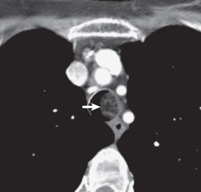 Fig. 56.3, Tracheal hamartoma. Axial CT image demonstrates a tracheal mass (arrow) arising from left lateral wall containing macroscopic foci of fat.