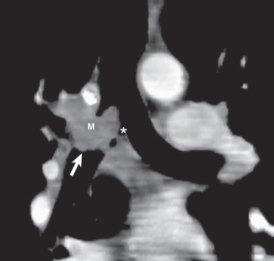 Fig. 56.4, Multiplanar reconstruction for assessment of extent of adenoid cystic carcinoma. Coronal reformatted image demonstrates a mass (M) arising at the level of the carina (asterisk), with extension into the right main bronchus (arrow) and paratracheal soft tissues.