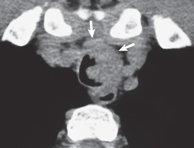 Fig. 56.5, Adenoid cystic carcinoma of the trachea. Axial CT scan shows a lobulated polypoid endotracheal tumor with extensive involvement of the tracheal wall and extension into the adjacent mediastinum (arrows).