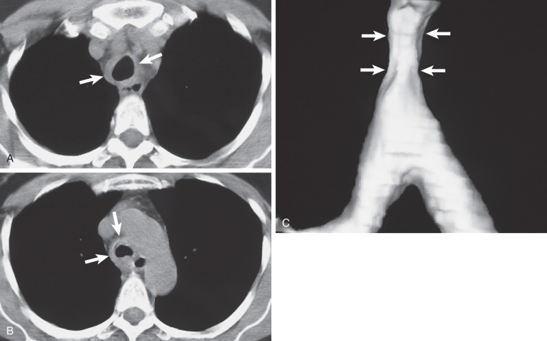 Fig. 56.6, Adenoid cystic carcinoma of the trachea. CT scans at the level of the great vessels (A) and at the level of the aortic arch (B) show circumferential thickening of the tracheal wall (arrows) . (C) Volumetric coronal reformatted image shows the extent of the tracheal narrowing (arrows).