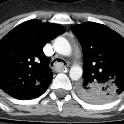 Fig. 56.9, Mucoepidermoid carcinoma of the trachea. CT scan shows a heterogeneously enhancing tumor along the posterior tracheal membrane. Note left lower lobe consolidation and small left pleural effusion from aspiration pneumonia.