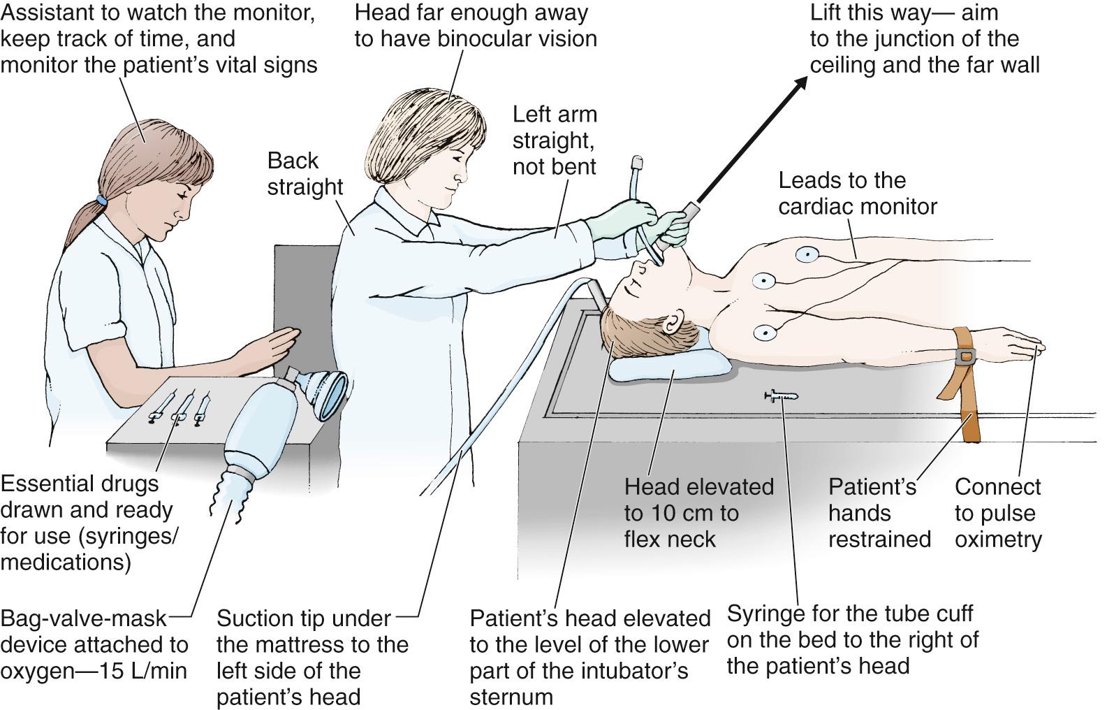 Figure 4.11, Proper positioning of the clinician, patient, and assistant for tracheal intubation. The following points are demonstrated: the difficult airway cart is adjacent to the patient, the suction device is at the head of the bed, the patient is in the “sniffing position” with the occiput elevated and the clinician's right hand ready for additional adjustment if necessary, the bed is elevated and the clinician is at the appropriate distance from the patient, and the laryngoscope handle is angled at 45 degrees.