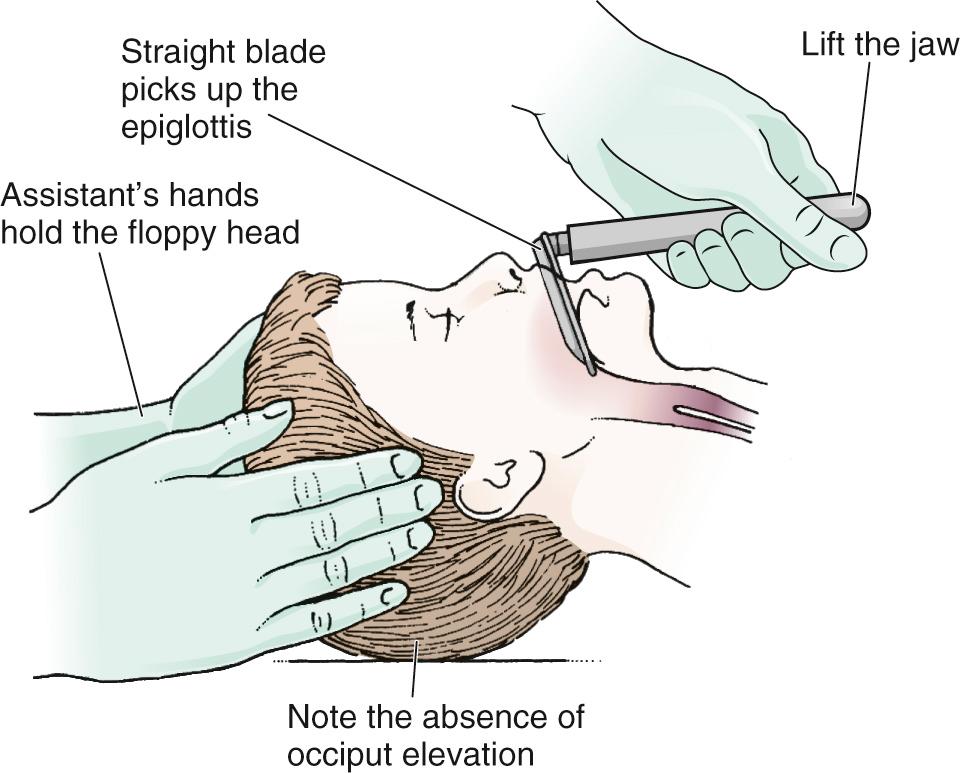 Figure 4.14, Oral intubation in a child with a straight blade. The proportionately large floppy head of a child may present some difficulty, and an assistant may be required to hold the child's head straight.