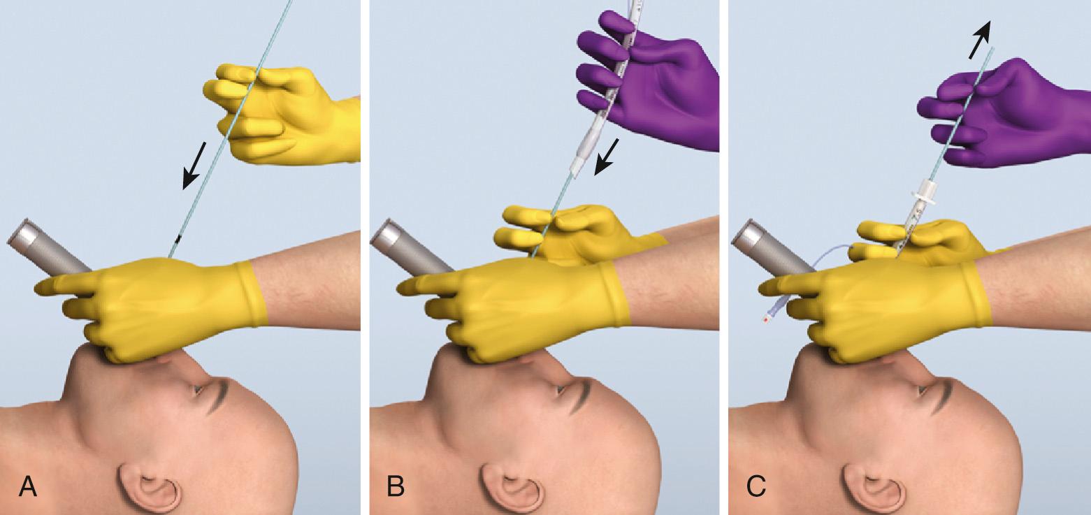 Figure 4.19, Two-person tracheal tube introducer technique. The introducer is handed to the clinician after the best glottic view has been obtained. A, The clinician places the introducer (the black line positioned at the teeth indicates the proper introducer depth to ensure stable positioning within the trachea while providing enough length to grasp the end of the introducer before passing the tube). B, An assistant passes the tracheal tube over the introducer as the clinician holds the introducer steady. C, The clinician passes the tracheal tube with a 90-degree counterclockwise rotation as the tube approaches the glottis, and the assistant withdraws the introducer.