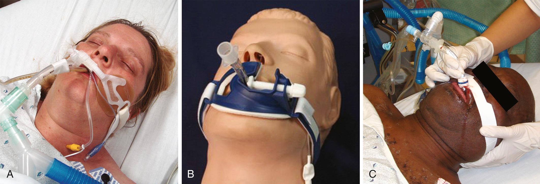 Figure 4.22, A, A commercial disposable tube holder is ideal and preferred to secure an endotracheal (ET) tube without the use of messy tape. B, A plastic disposable ET holder firmly secures the ET tube with a small clamp. C, When positioning a patient for transfer to another bed or for a chest radiograph, ensure the integrity of the ET tube by placing the right hand firmly against the right side of the face while holding the tube securely with the same hand. The other hand immobilizes the neck.