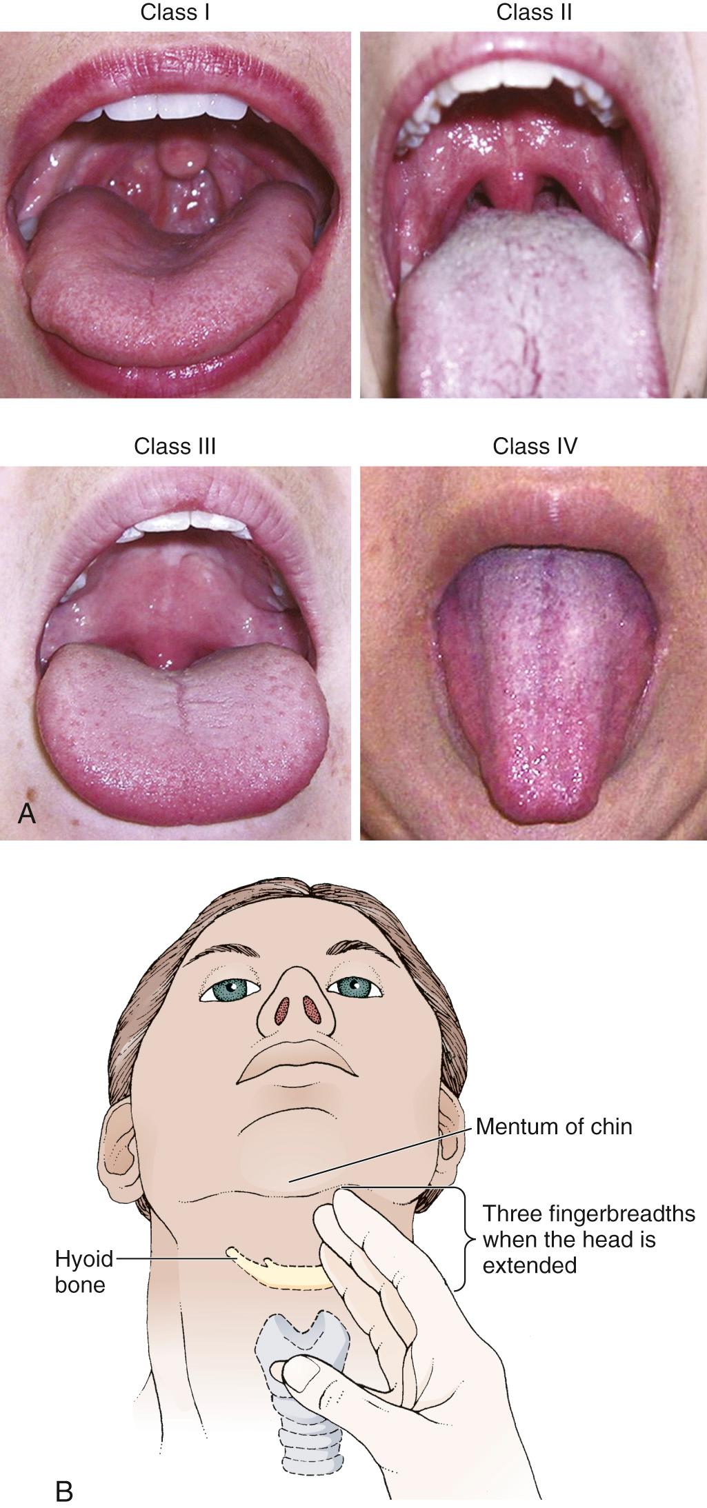 Figure 4.3, A, The Mallampati classification predicts intubation difficulty based on the visibility of intraoral structures. Classes III and IV predict difficult intubation. B, A short thyromental distance (less than 6 cm or 3 fingerbreadths) when the head is extended predicts difficult intubation.