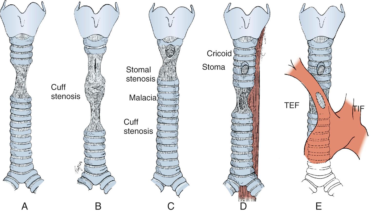 FIGURE 8-2, Diagrams of principal postintubation tracheal lesions. A, Cuff stenosis from the cuff of an endotracheal tube. B, Cuff stenosis from the cuff of a tracheostomy tube, usually lower in the trachea than that from an endotracheal tube. Stoma stenosis also occurs at the site of the tracheostomy itself. Malacia can occur either at the level of the cuff or in the segment between the stoma and the cuff stenosis. C, Cuff stenosis at the site of a high tracheostomy stoma, which has eroded into the lower margin of the cricoid cartilage. In older patients, this can erode back further into the subglottic larynx, producing a laryngotracheal stenosis. D, Tracheoesophageal fistula (TEF) produced by pressure of the cuff against the membranous wall, often abetted by an indwelling, firm, nasogastric tube. E, One type of tracheoinnominate fistula (TIF) is the result of a high-pressure cuff erosion. The more common type, but also rare, is that seen with a low-placed tracheostomy stoma, which rests against the innominate artery itself. Not shown here are the lesions that occur in the larynx as the result of endotracheal tubes.