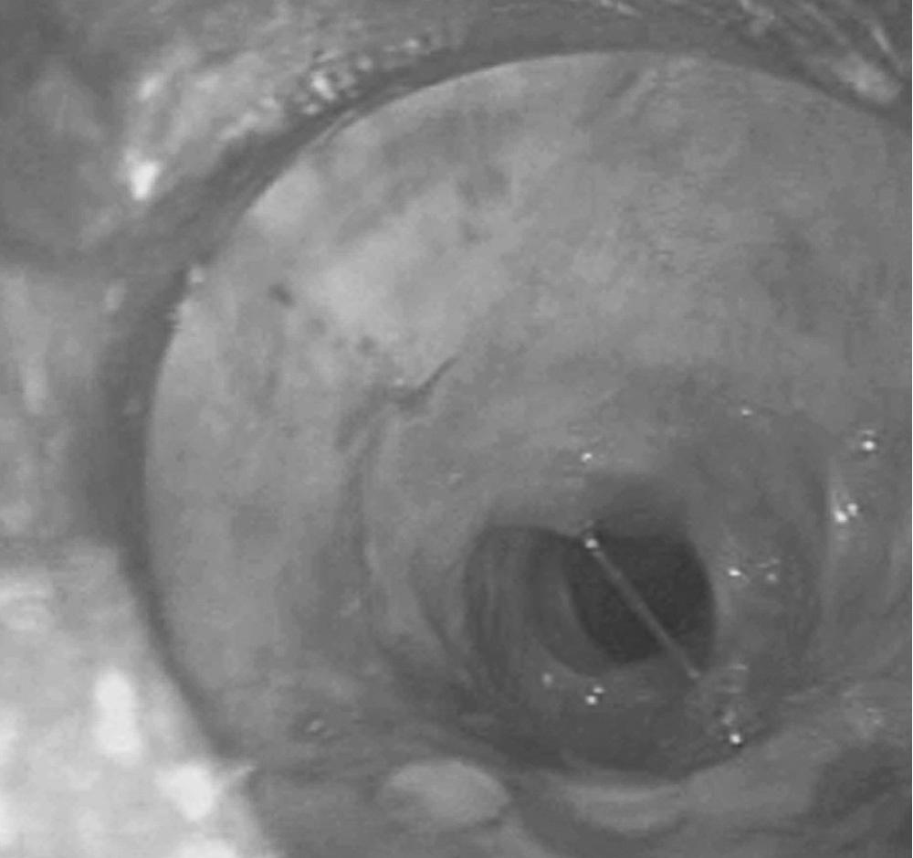 FIGURE 8-3, Cuff-level stenosis. The stenosis here is circumferential, and the remaining lumen is round.