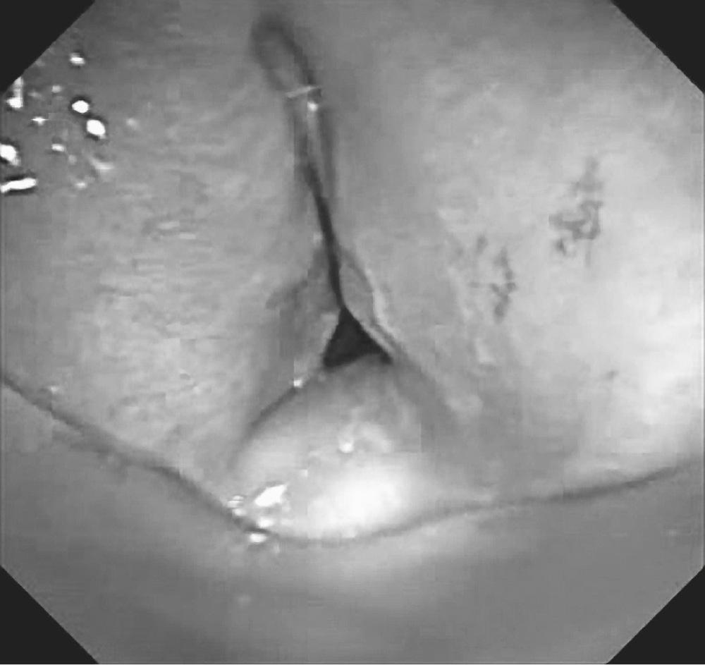 FIGURE 8-4, Tracheostomy stomal site stenosis. The characteristic A-shaped lumen is evident and results from a primarily anterior and lateral cicatricial process.